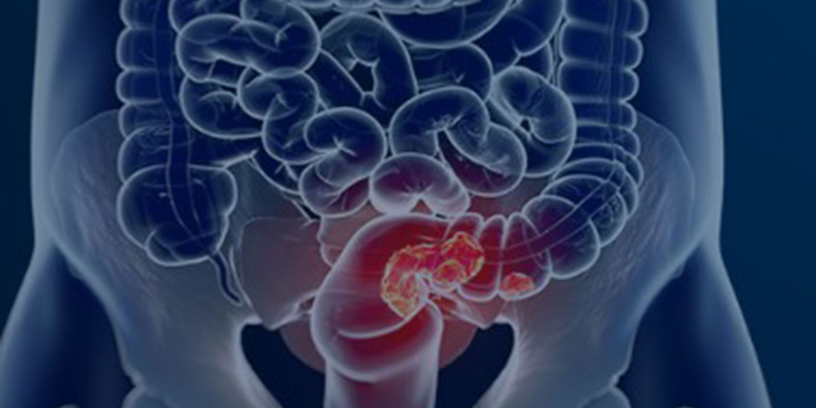 Estudo projeta aumento de 36% em mortes por câncer colorretal até 2040