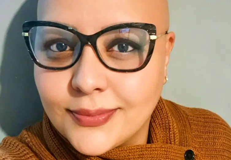 Arquivo pessoal Brasília - DF - A alopecia areata é uma doença autoimune, caracterizada pelo ataque ao folículo piloso. ( Juliana Fernandes convive com a alopecia areata universal há mais de 20 anos). Foto: arquivo pessoal